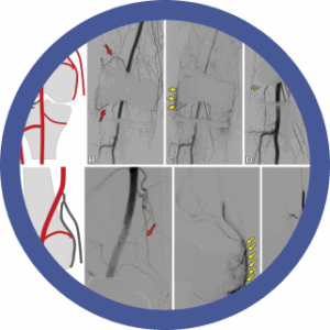 Nuevo Webinar Embolización MSK con Lipiodol: tratamiento de enfermedades crónicas como la osteoartritis