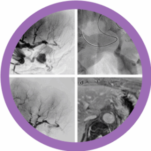 Nuevo Webinar: Aplicaciones de la embolización vascular con Lipiodol