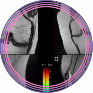 RM de Rodilla: Más Allá del Informe Radiológico