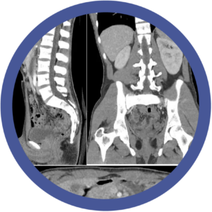 Imagenología de Urgencias Abdominales: De la teoría a la práctica.